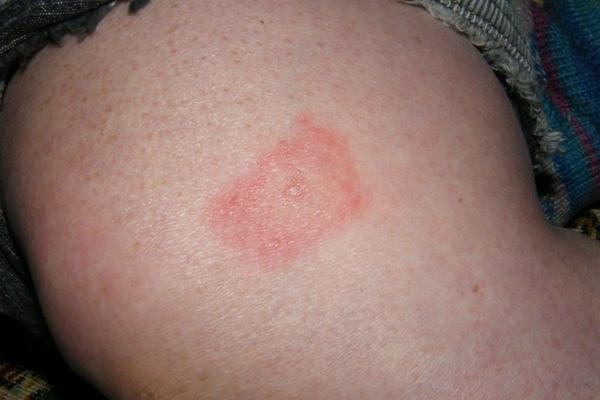 Lyme Disease rash